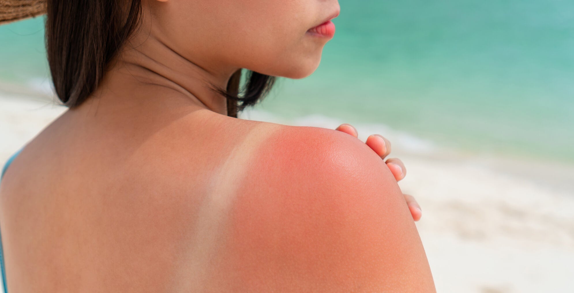 Apaiser un coup de soleil qui gratte