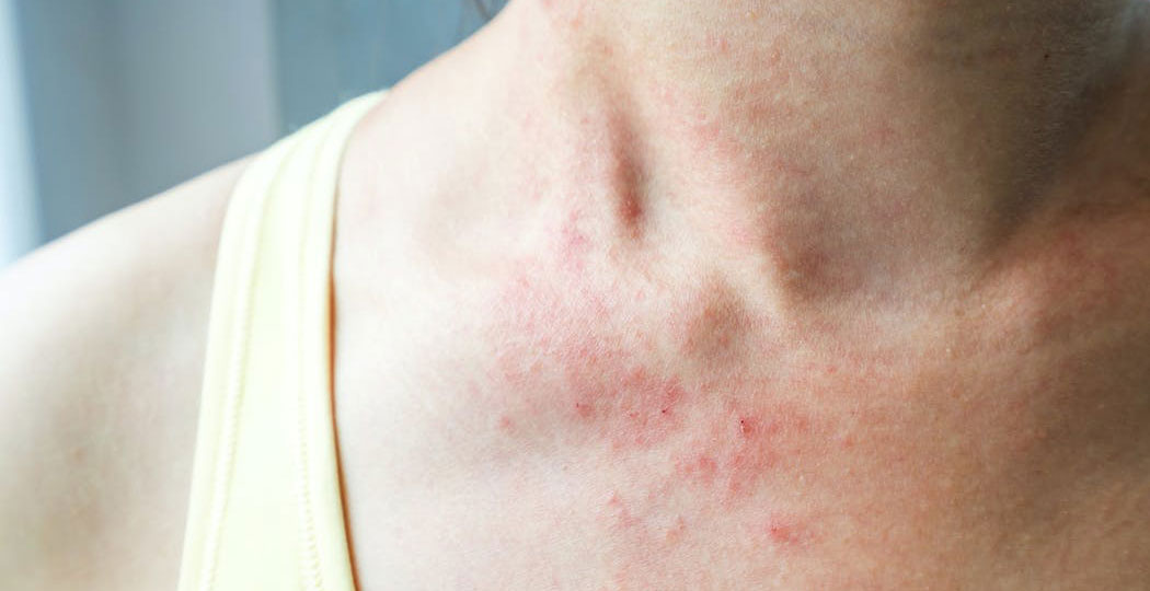 Soulager l’eczéma visage avec des traitements naturels