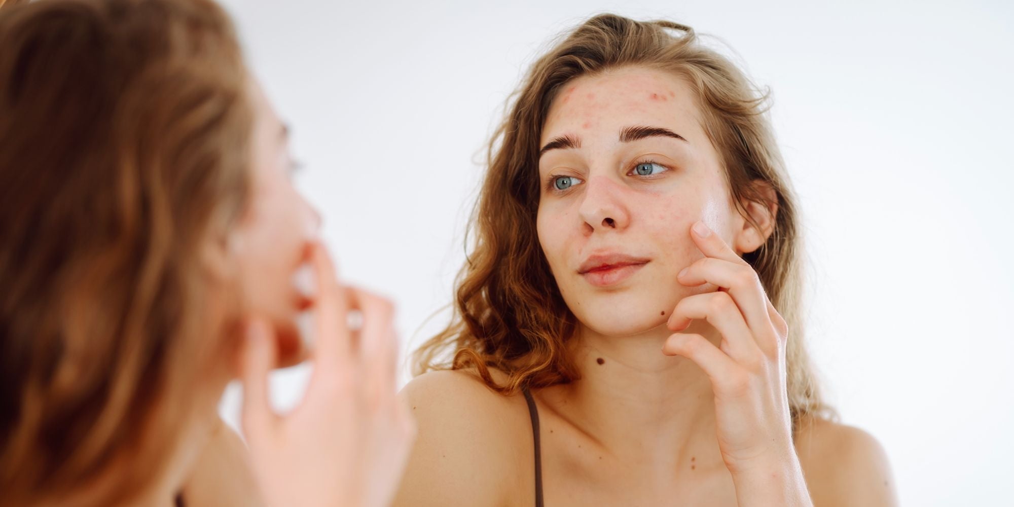 Femme avec la peau grasse et déshydratée