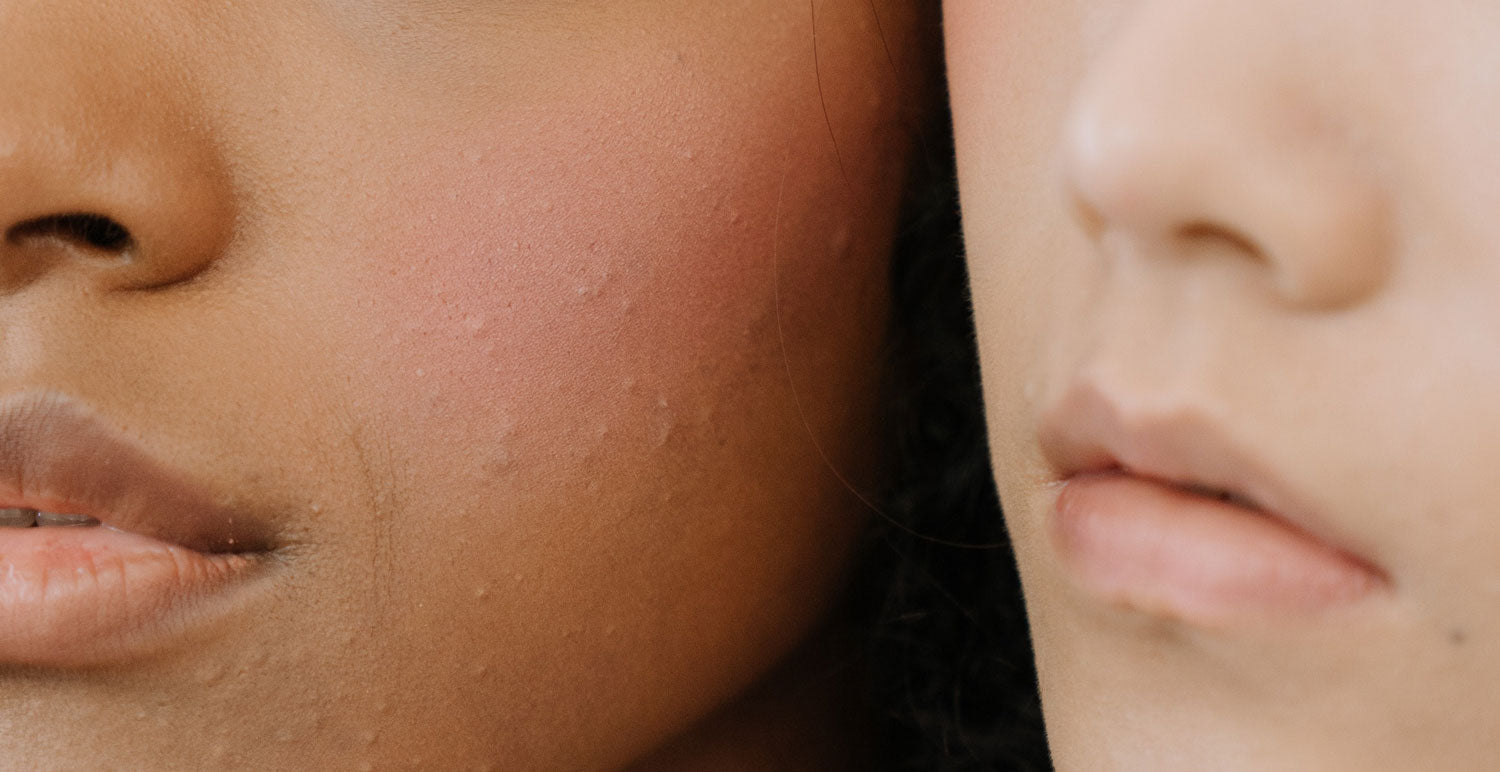 Boutons après soleil : comment faire