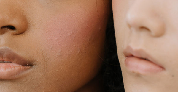 Image Poussée de boutons après l'été : que faire ?