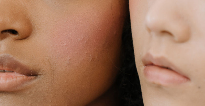 Poussée de boutons après l'été : que faire ?