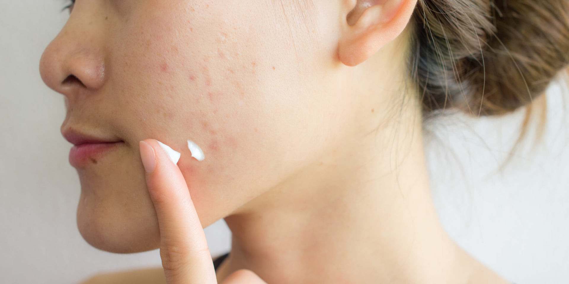 Appliquer du dentifrice sur un bouton : bonne au mauvaise idée ?
