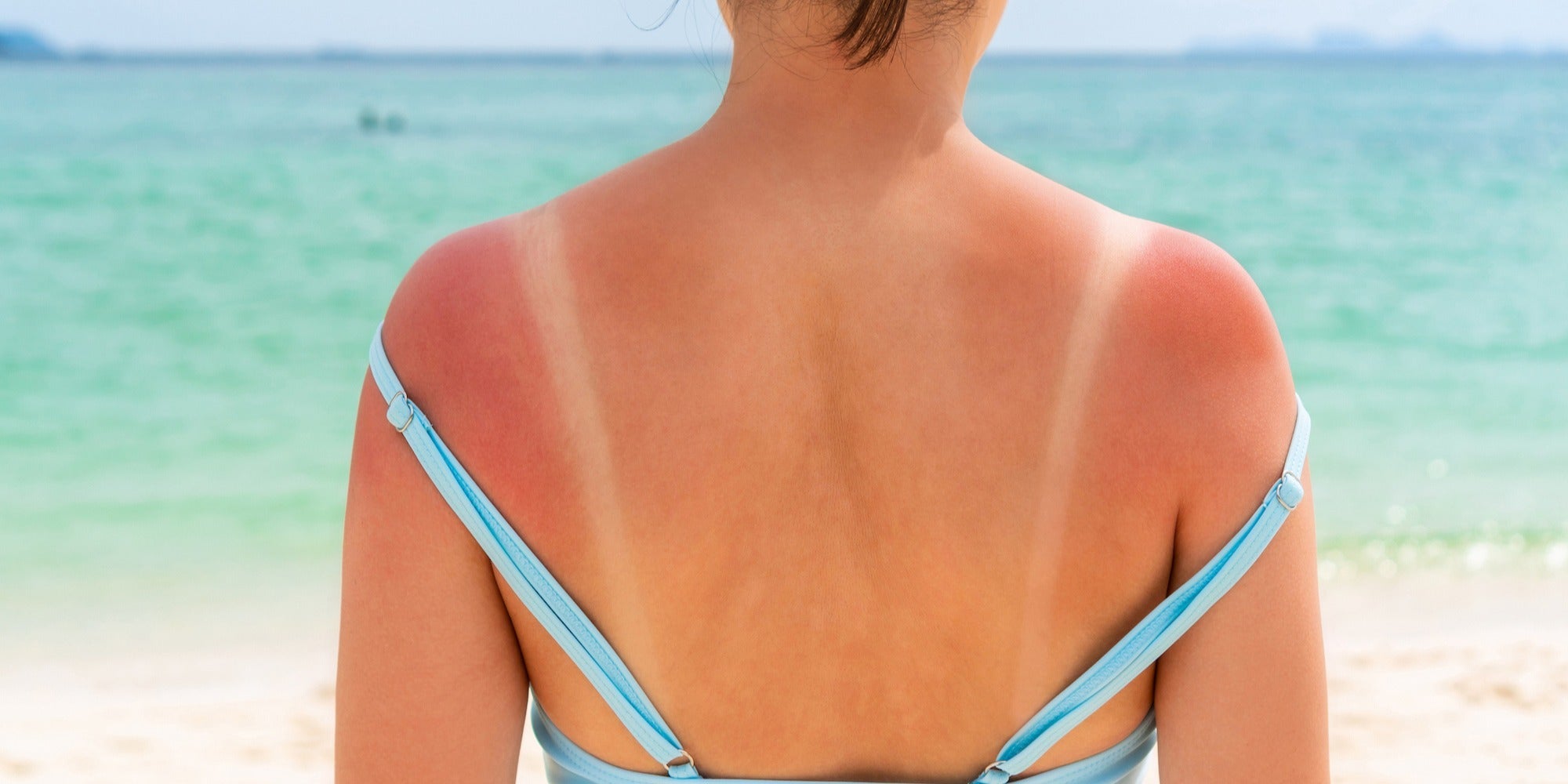 la durée d'un coup de soleil varie selon le type de brûlure