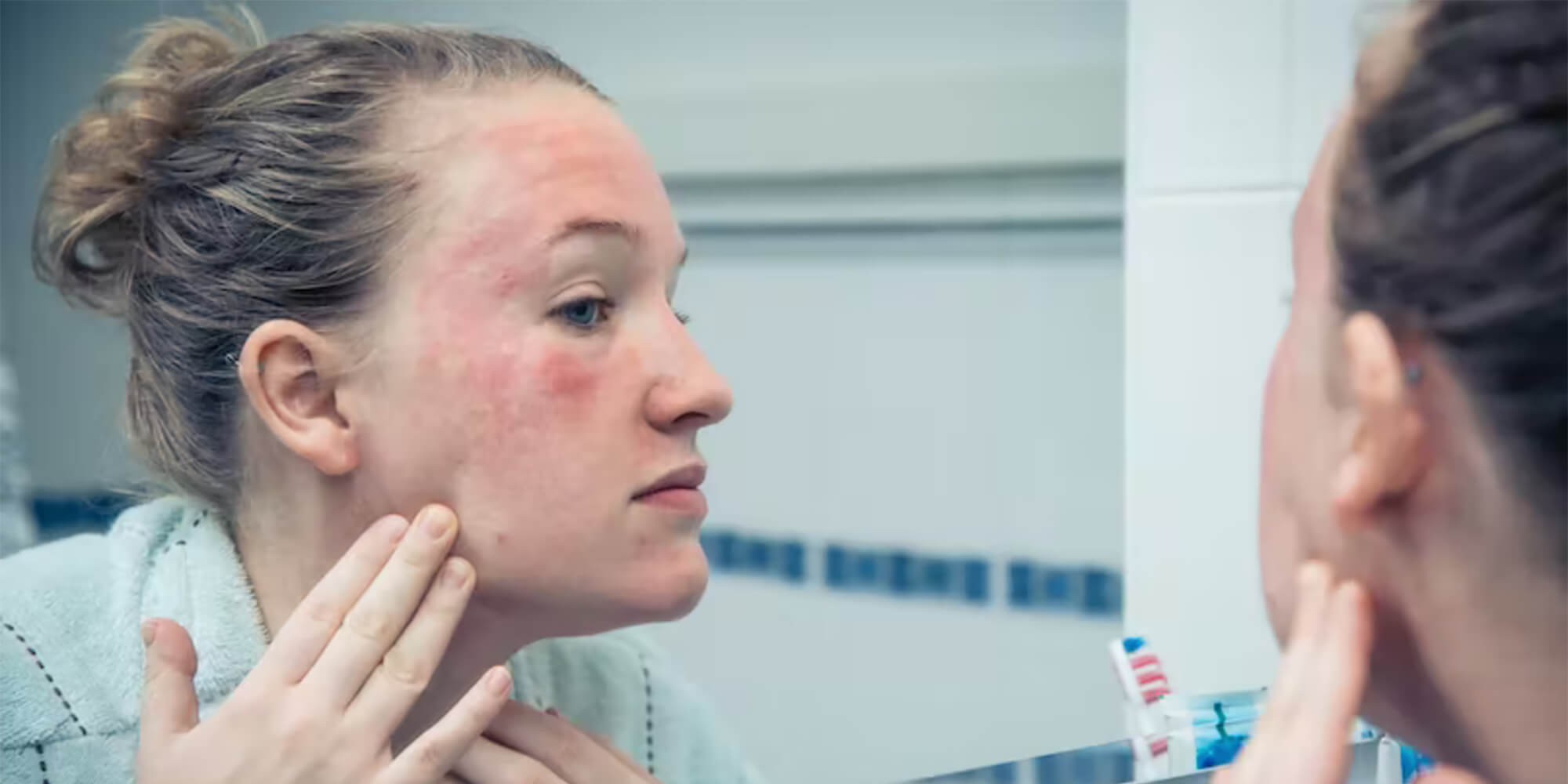 psoriasis visage