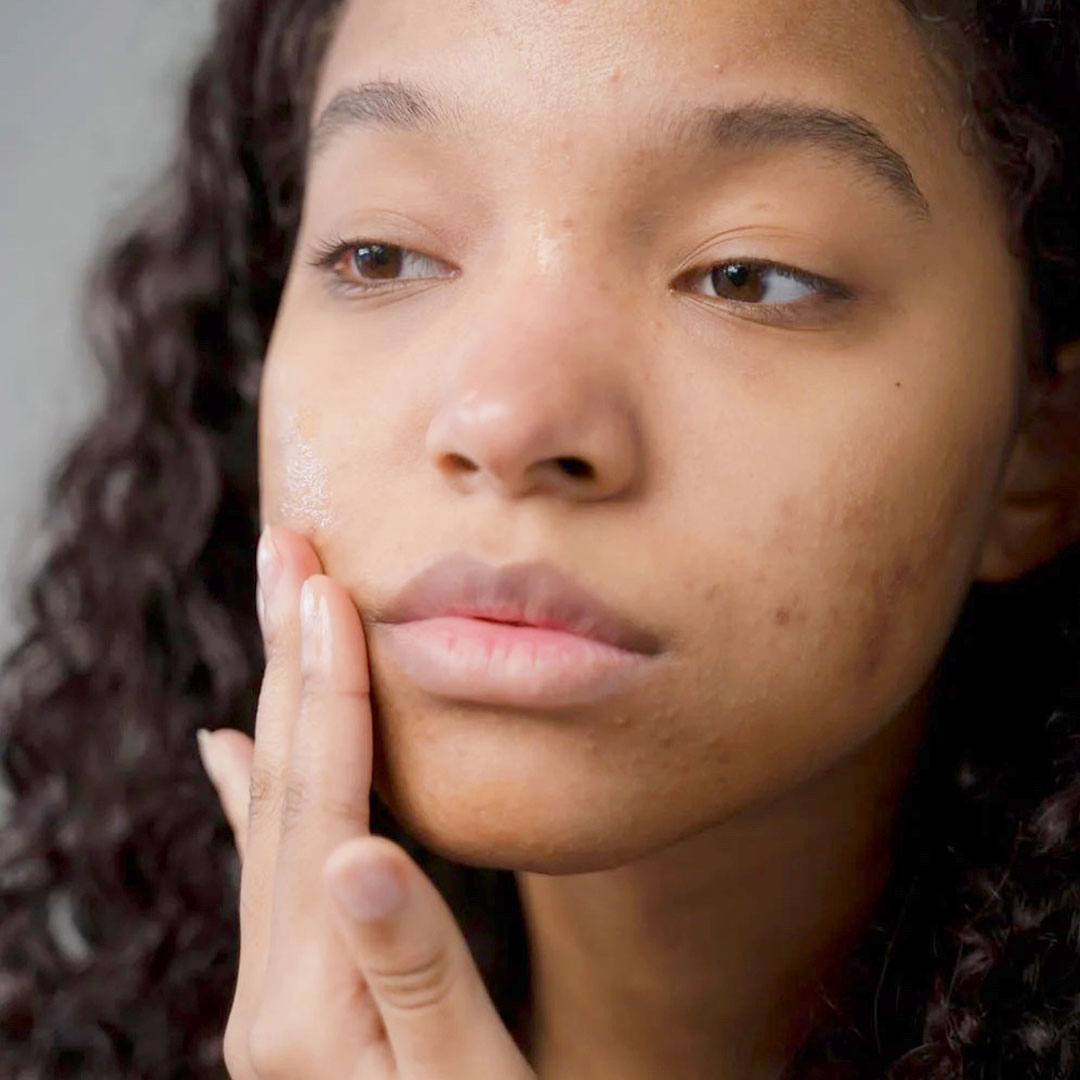Acné hormonale quelles solutions