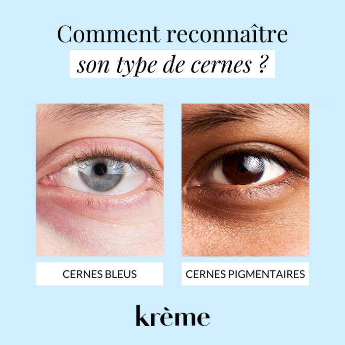 Cernes bleus ou cernes pigmentaires ?